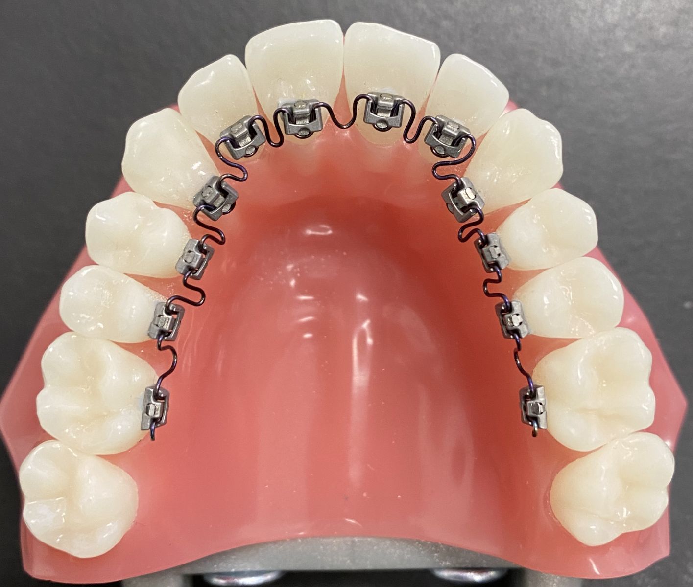 Types of Braces - Talbot Orthodontics